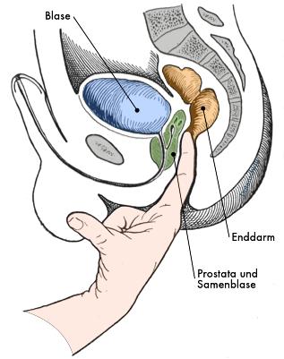 Tasten der Prostata